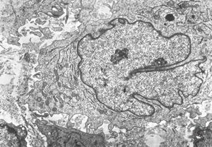 M, 1y. | histiocytosis X (eosinophilic granuloma) … Langerhans cell M, 1y. | histiocytosis X (eosinophilic granuloma) … Langerhans cell